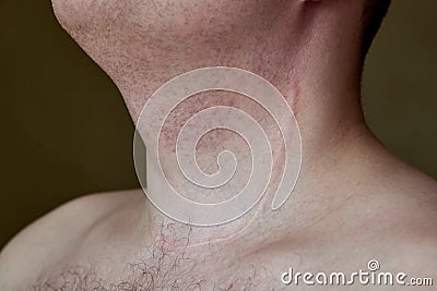 Scar on the neck of a man after removal of the thyroid gland Stock Photo
