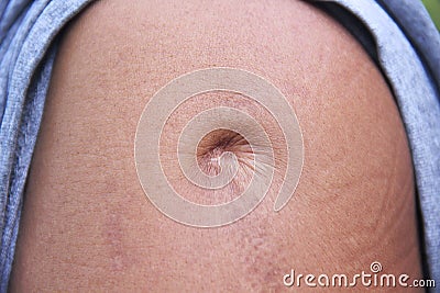 Scar skin from a bullet hole on asian men`s shoulder Stock Photo