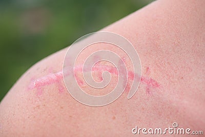 Scar. Skin wound. Plastic surgery. Scarification. White skin with a pink surgical scar on shoulder. Female shoulder and Stock Photo