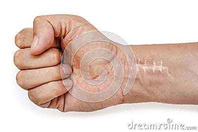 Scar with stitches on the wrist after surgery. Fracture of the bones of the hands in fist isolated on white background Stock Photo