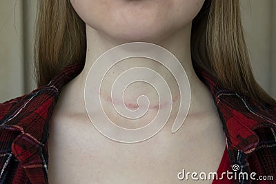 scar after surgery on woman neck Stock Photo