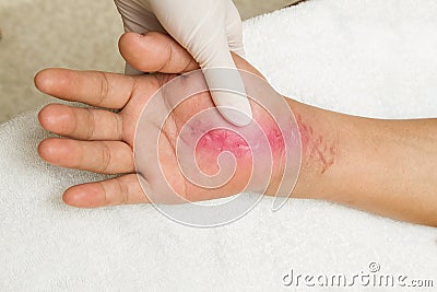 Scar wound on hand. hand injury Stock Photo