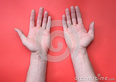 a scar on the wrist from tendon and nerve surgery, a cut on the hand Stock Photo
