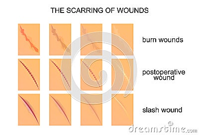 The scarring of wounds Vector Illustration