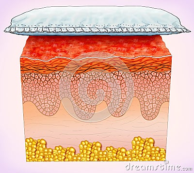 Schematic illustration of a segment of skin affected by diaper rash Stock Photo