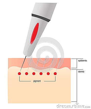 The scheme of the procedure of permanent makeup. Stock Photo