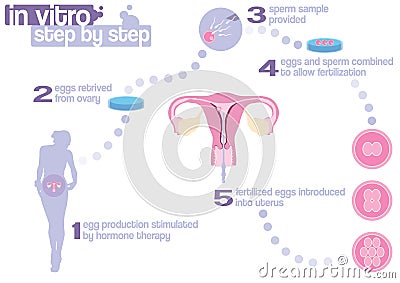 Scheme of in vitro fertilization Stock Photo