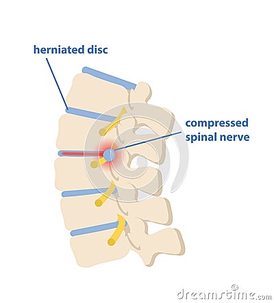 Sciatic nerve pinching concept Vector Illustration