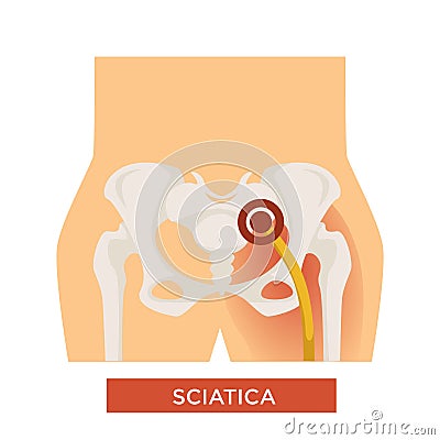 Sciatica bone disease sciatic back pain hip bone Vector Illustration