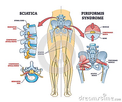 Sciatica vs piriformis medical muscle conditions comparison outline diagram Vector Illustration