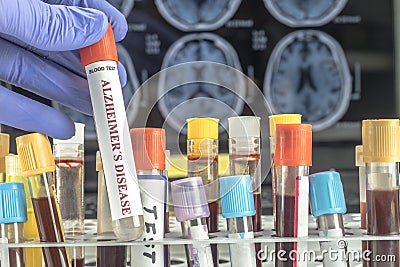 Scientist holds blood sample to investigate remedy against Alzheimer`s disease Stock Photo