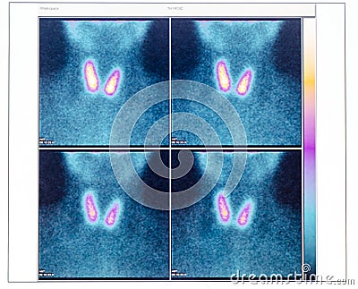 Scintigraphy of thyroid gland with two nodule Stock Photo
