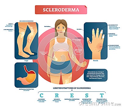 Scleroderma vector illustration. Autoimmune skin and blood disease. Vector Illustration