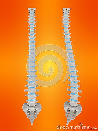 Scoliosis Cartoon Illustration