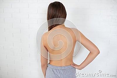 Scoliosis in adolescents. Poor posture in a teenage girl. How to check your posture at home. lordosis, kyphosis, slouching Stock Photo