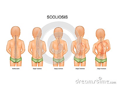 Scoliosis in children Vector Illustration