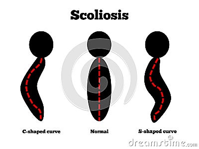 Scoliosis Vector Illustration