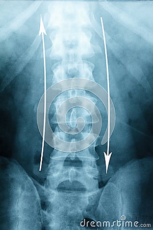 X-ray Scoliosis film x-ray lumbar spine AP Stock Photo