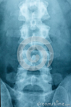 X-ray Scoliosis film x-ray lumbar spine AP Stock Photo