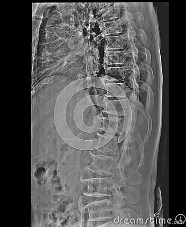 Scoliosis film x-ray lumbar spine Stock Photo