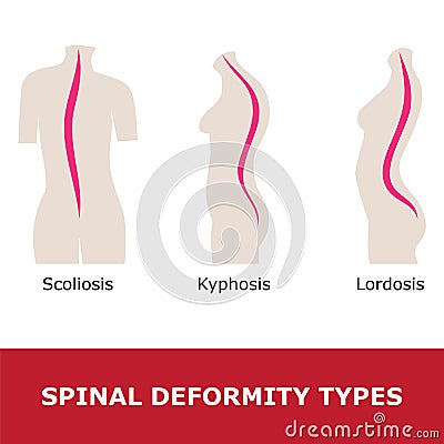 Scoliosis, lordosis and kyphosis Vector Illustration