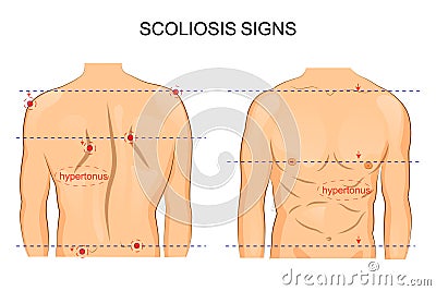 Scoliosis of the spine. signs Vector Illustration