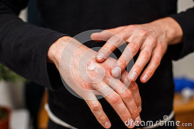 Scratch Allergic skin from eczema or psoriasis and apply steroids medicine cream, Healthcare And Medicine concpet. Treatment on re Stock Photo