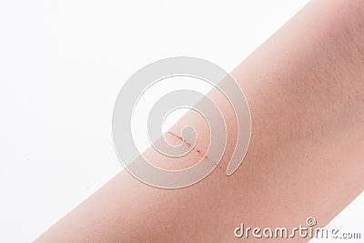 Scratch scar in hand Stock Photo