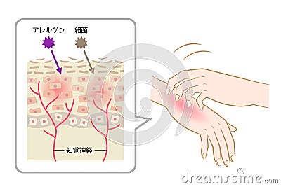 Scratching itch hands. redness rash and skin cell illustration. Healthy skin care concept Stock Photo