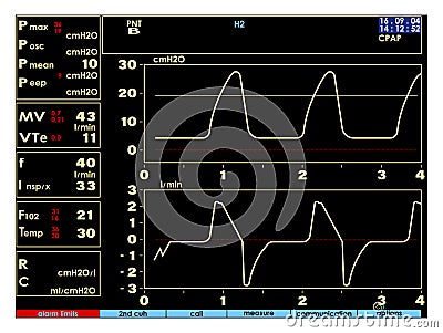 Screen, monitor with signs of the artificial lung ventilation device in a realistic design. Isolated vector Vector Illustration