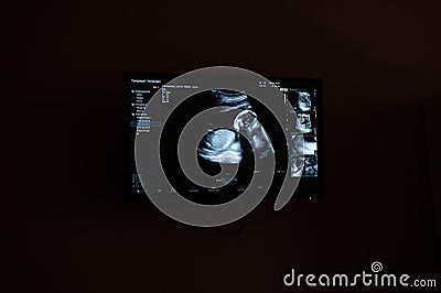 Screen shot of a second trimester prenatal screening. Stock Photo