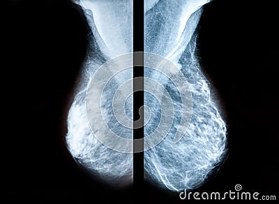 Screening for breast cancer Stock Photo