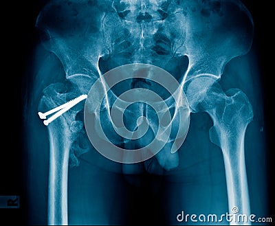 fixation hip Stock Photo