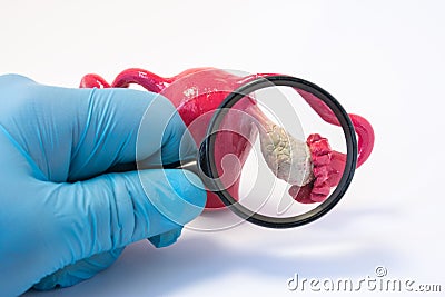 Search disease, abnormalities or pathology of ovary concept photo. Doctor holding magnifying glass and examines model of ovaries, Stock Photo