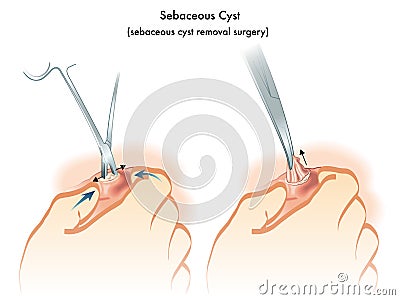 Sebaceous cyst Vector Illustration