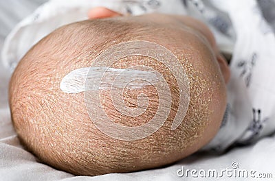 Seborrheic dermatitis on baby`s head with cream on it. Stock Photo