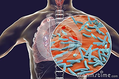 Secondary tuberculosis in lungs and close-up view of Mycobacterium tuberculosis bacteria Stock Photo