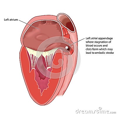 Heart left atrial appendage Vector Illustration