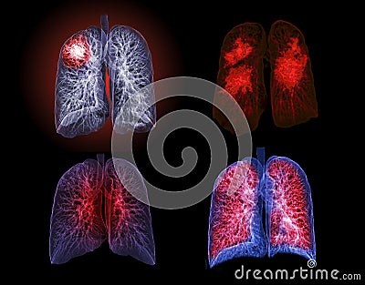 Selective focus of CT Chest or Lung 3D rendering image on the monitor for diagnosis TB,tuberculosis and covid-19 Stock Photo