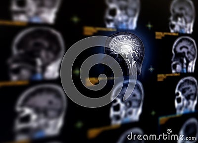 Selective focus of MRI brain sagittal plane Stock Photo