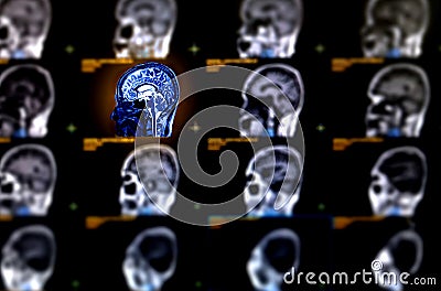 Selective focus of MRI brain sagittal plane Stock Photo