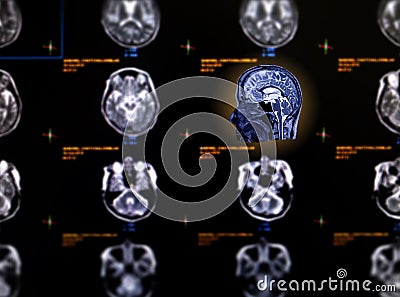 Selective focus of MRI brain sagittal view Stock Photo