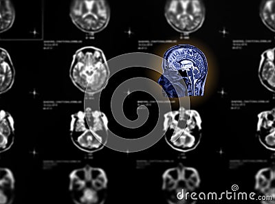 Selective focus of MRI brain sagittal view . Stock Photo