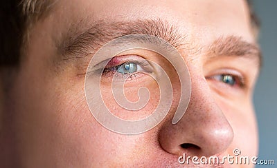 Selective focus on swollen and painful red upper eye lid with onset of stye infection due to clogged oil gland and Stock Photo