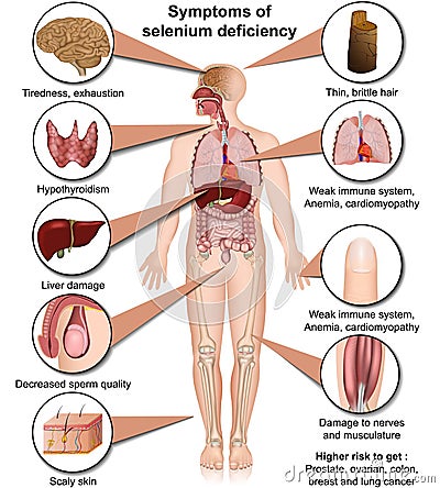 Selenium deficiency medical vector illustration isolated on white background infographic Vector Illustration