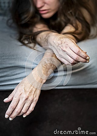 Self harm on frustrated disillusioned sick woman lying on bed with heavy self inflicted Cuts and scars of self-mutilation in Stock Photo