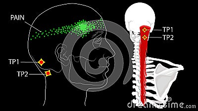 Semispinalis muscles. Trigger points and referred pain Stock Photo