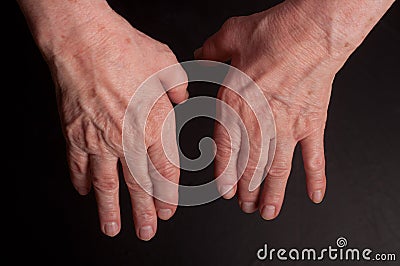 Senior hands. Suffering from pain and rheumatism Stock Photo