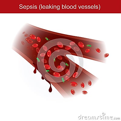 Sepsis. When the body has immune response to bacterial infections, causing inflammation and leaking blood vessels in the body Vector Illustration