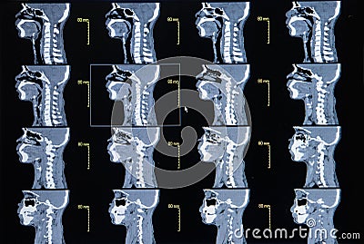 Series of images from a computerized tomography of neck Stock Photo